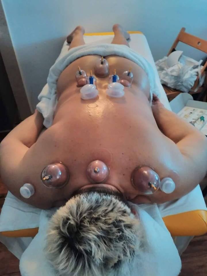 Baňkování zad